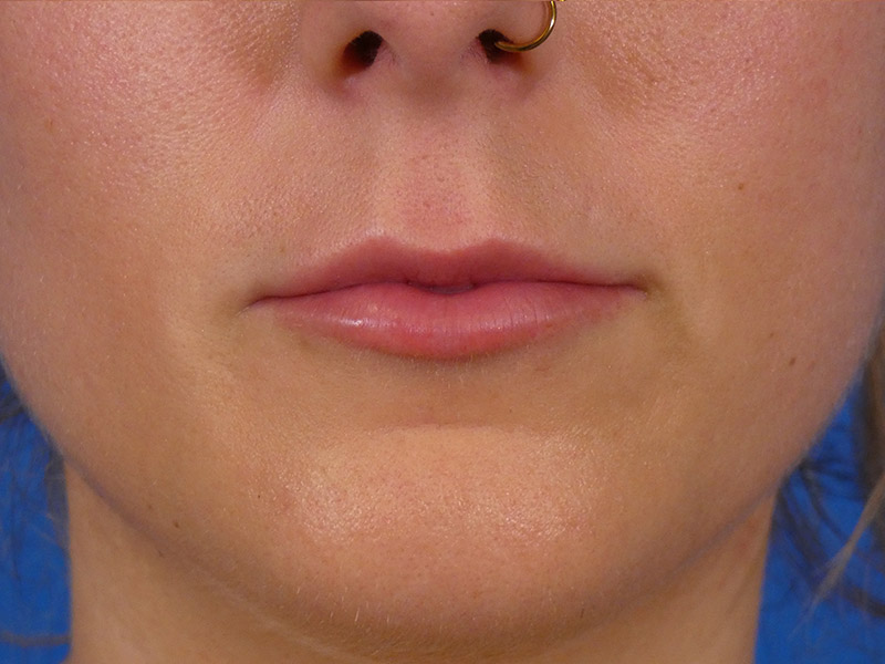 Lip Filler Before and After | Plastic Surgery Associates of Valdosta