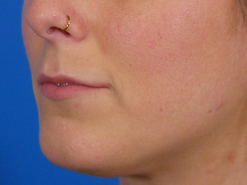 Lip Filler Before and After | Plastic Surgery Associates of Valdosta