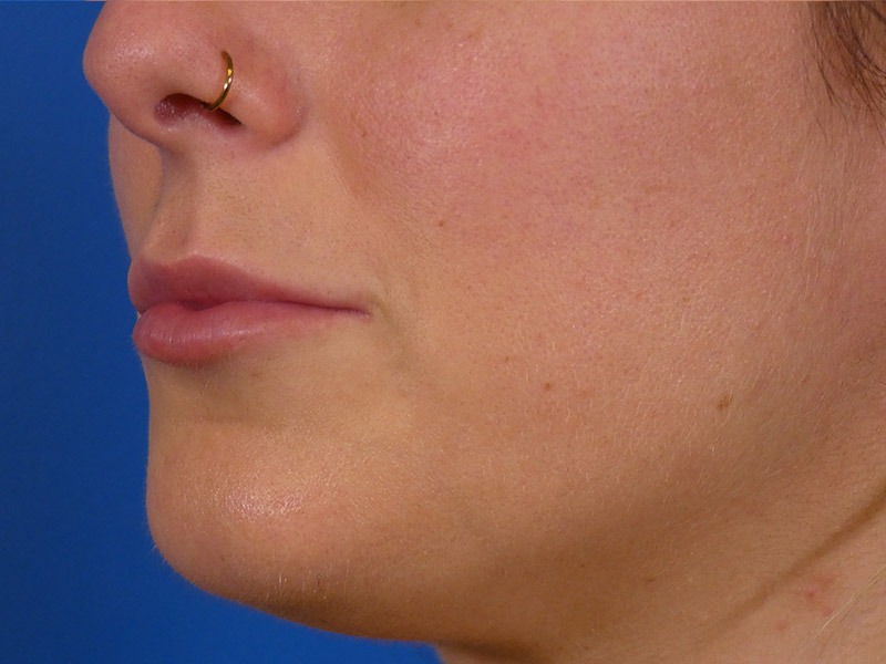 Lip Filler Before and After | Plastic Surgery Associates of Valdosta