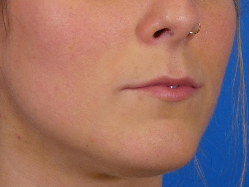 Lip Filler Before and After | Plastic Surgery Associates of Valdosta