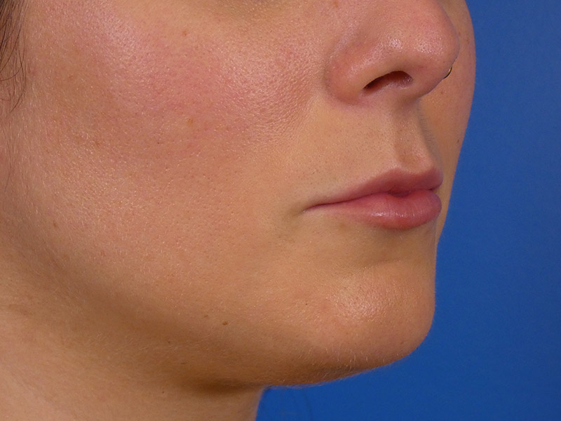 Lip Filler Before and After | Plastic Surgery Associates of Valdosta