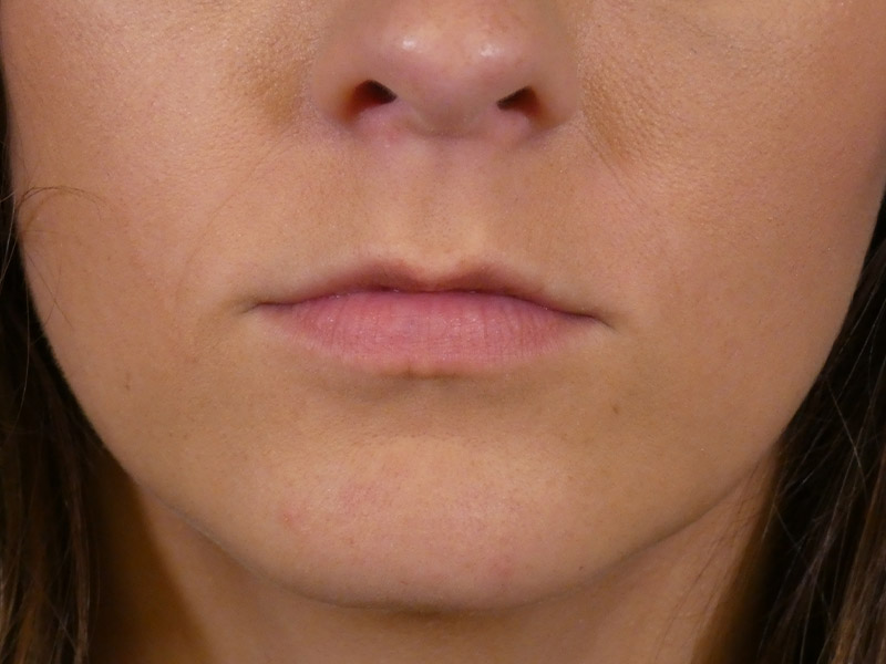 Lip Filler Before and After | Plastic Surgery Associates of Valdosta