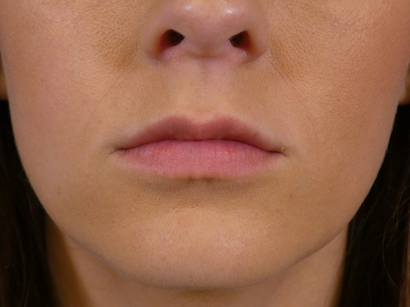 Lip Filler Before and After | Plastic Surgery Associates of Valdosta