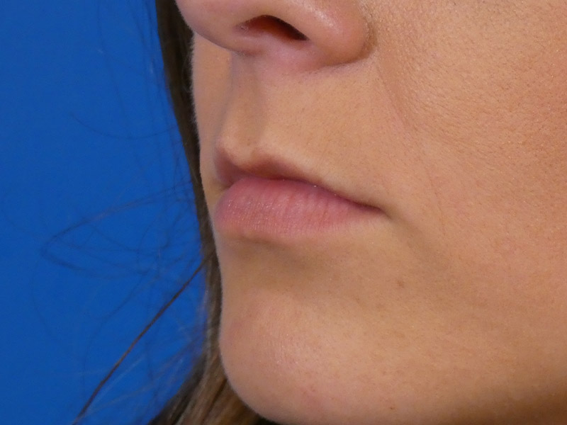 Lip Filler Before and After | Plastic Surgery Associates of Valdosta