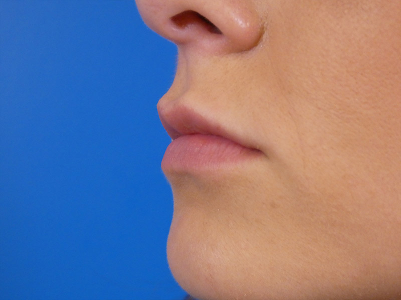 Lip Filler Before and After | Plastic Surgery Associates of Valdosta