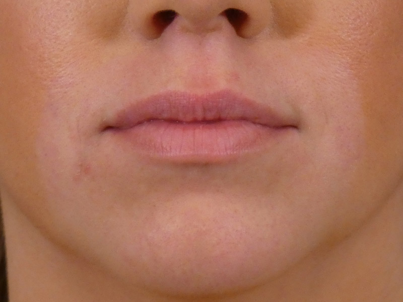 Lip Filler Before and After | Plastic Surgery Associates of Valdosta