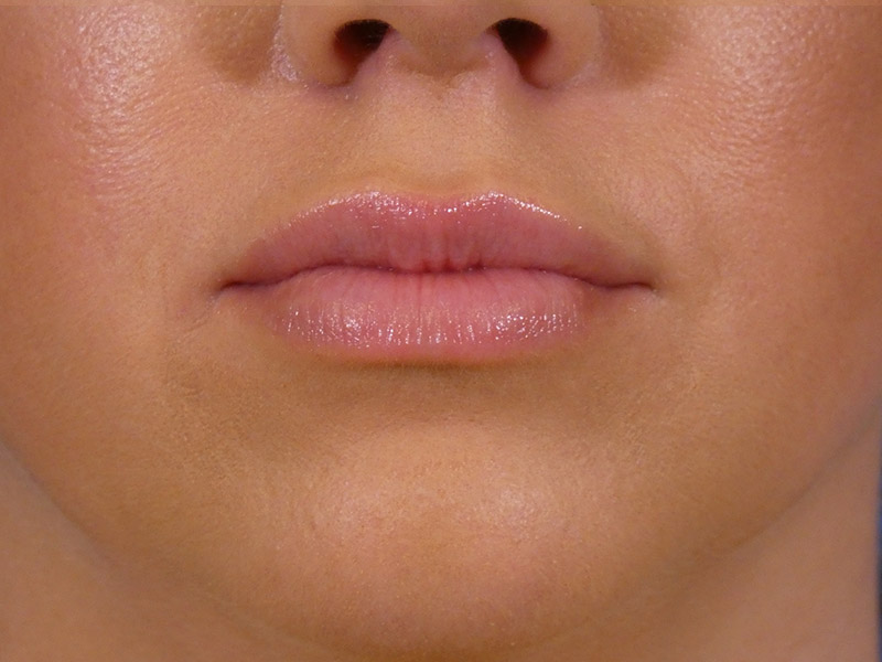 Lip Filler Before and After | Plastic Surgery Associates of Valdosta