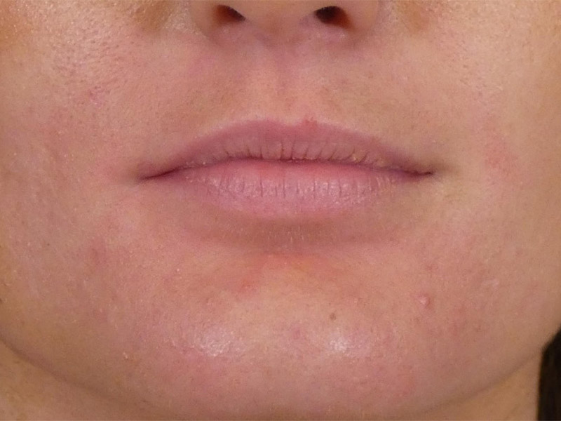 Lip Filler Before and After | Plastic Surgery Associates of Valdosta