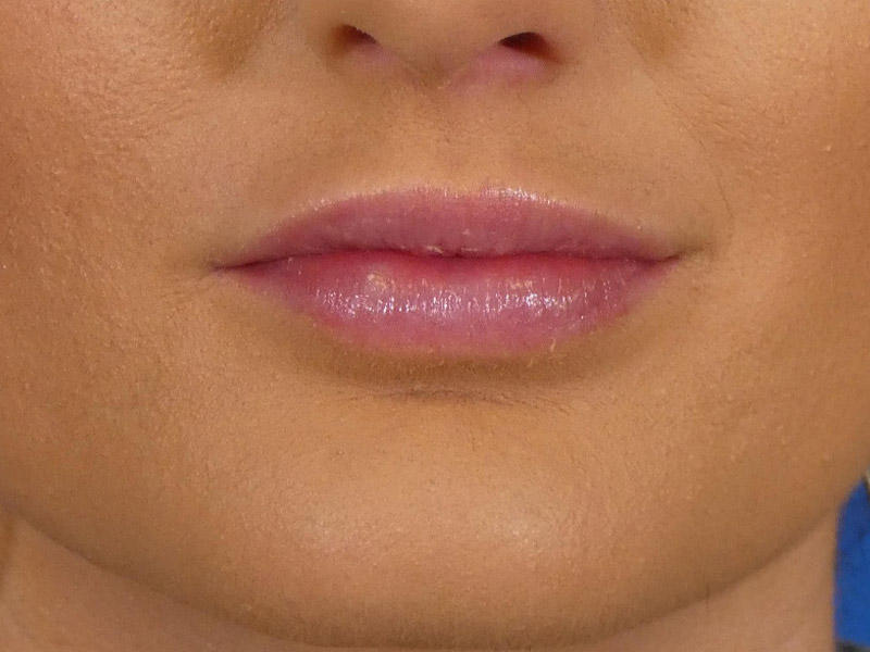 Lip Filler Before and After | Plastic Surgery Associates of Valdosta