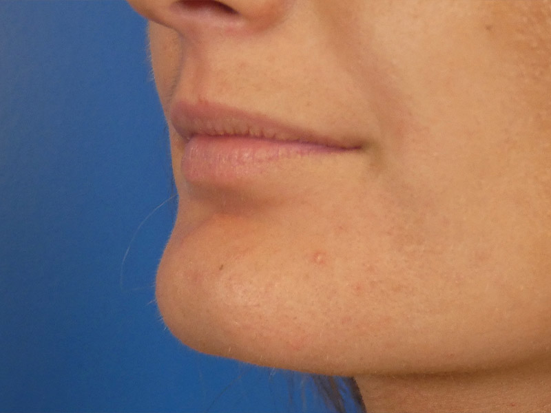 Lip Filler Before and After | Plastic Surgery Associates of Valdosta