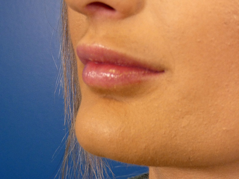 Lip Filler Before and After | Plastic Surgery Associates of Valdosta