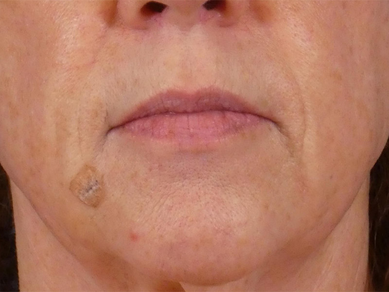 Lip Filler Before and After | Plastic Surgery Associates of Valdosta