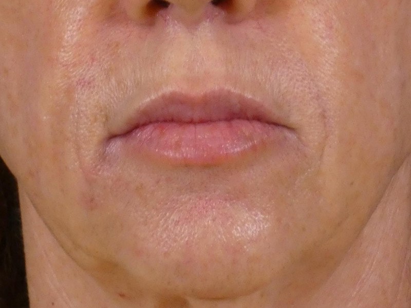 Lip Filler Before and After | Plastic Surgery Associates of Valdosta