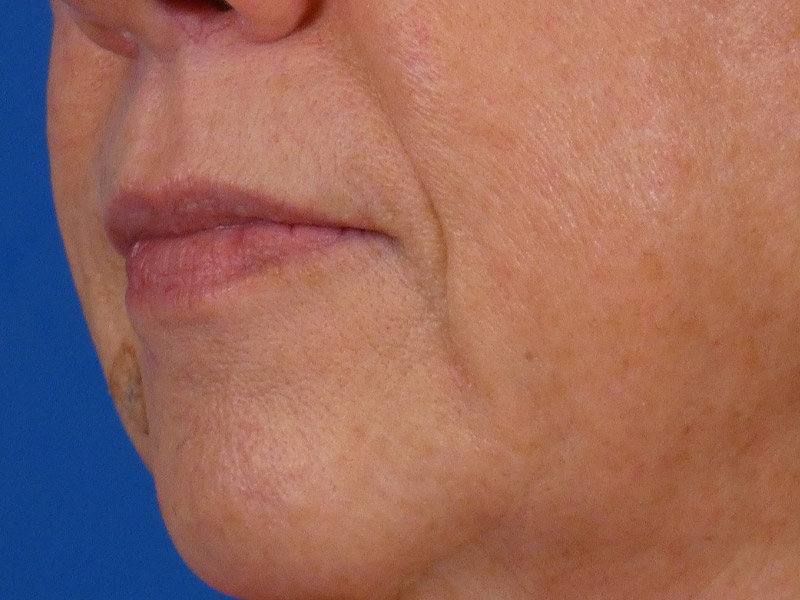 Lip Filler Before and After | Plastic Surgery Associates of Valdosta