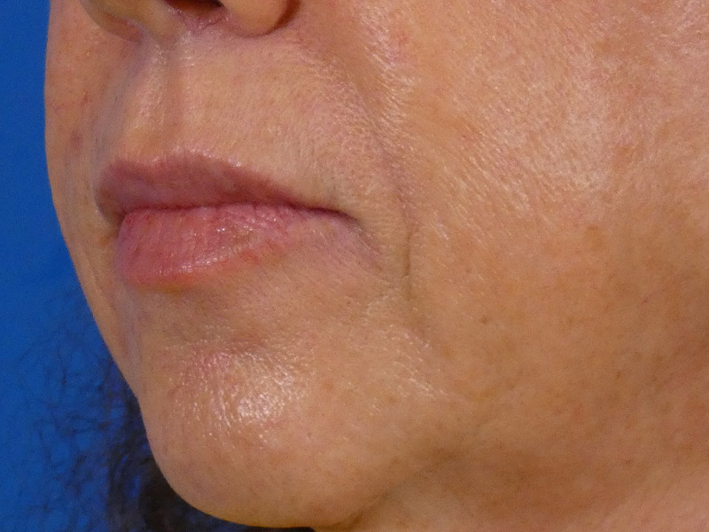 Lip Filler Before and After | Plastic Surgery Associates of Valdosta