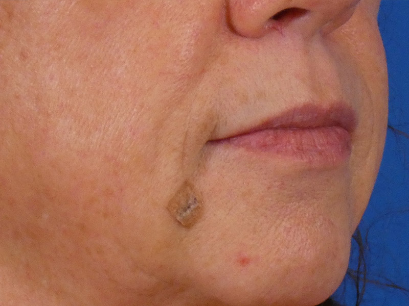 Lip Filler Before and After | Plastic Surgery Associates of Valdosta