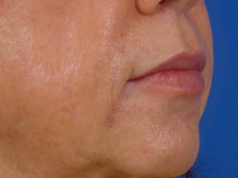 Lip Filler Before and After | Plastic Surgery Associates of Valdosta