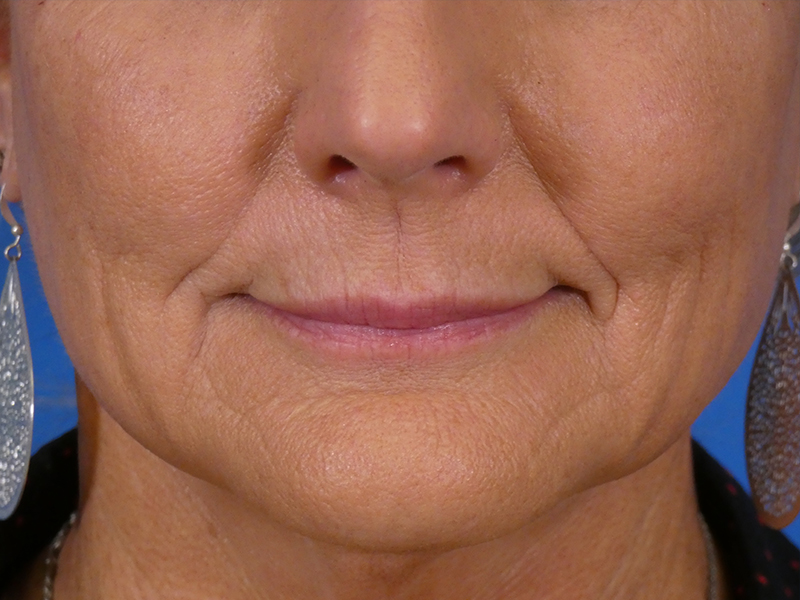 Lip Filler Before and After | Plastic Surgery Associates of Valdosta