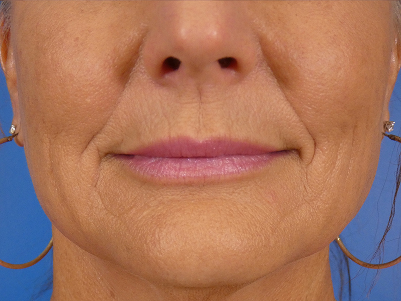 Lip Filler Before and After | Plastic Surgery Associates of Valdosta