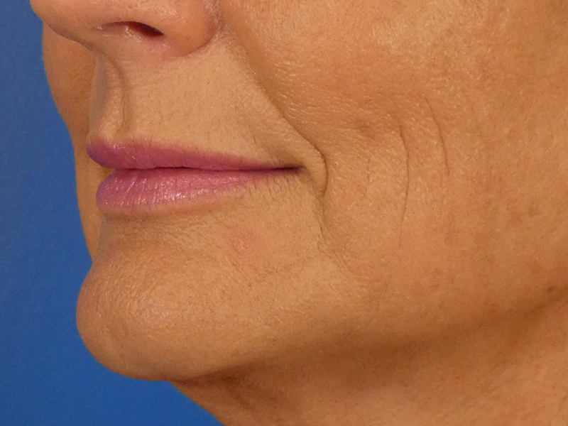 Lip Filler Before and After | Plastic Surgery Associates of Valdosta