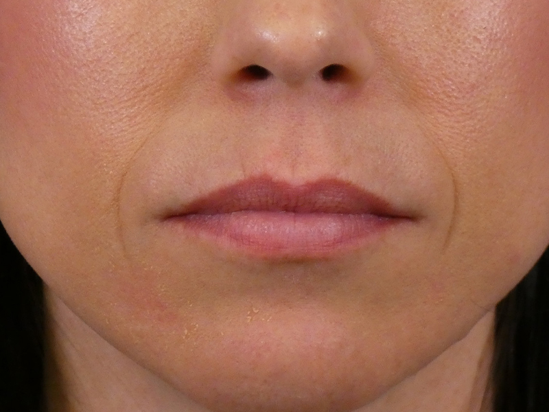 Lip Filler Before and After | Plastic Surgery Associates of Valdosta