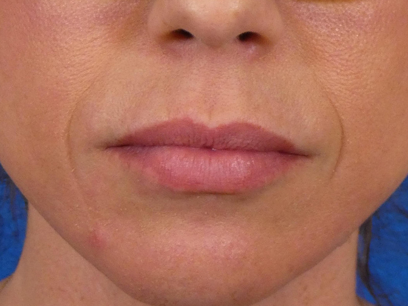 Lip Filler Before and After | Plastic Surgery Associates of Valdosta