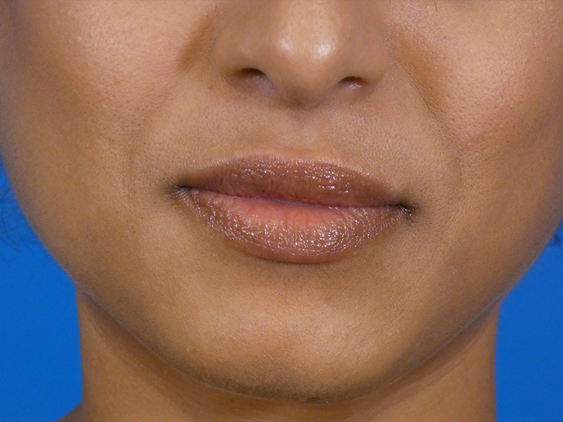 Lip Filler Before and After | Plastic Surgery Associates of Valdosta