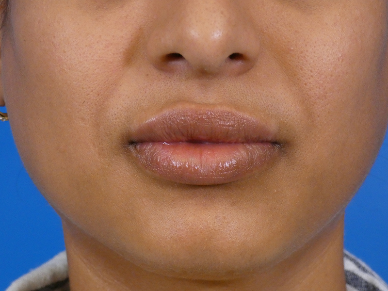 Lip Filler Before and After | Plastic Surgery Associates of Valdosta