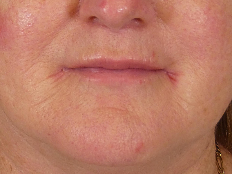 Lip Filler Before and After | Plastic Surgery Associates of Valdosta