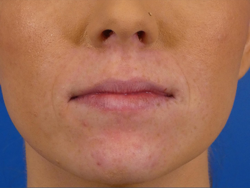 Lip Filler Before and After | Plastic Surgery Associates of Valdosta