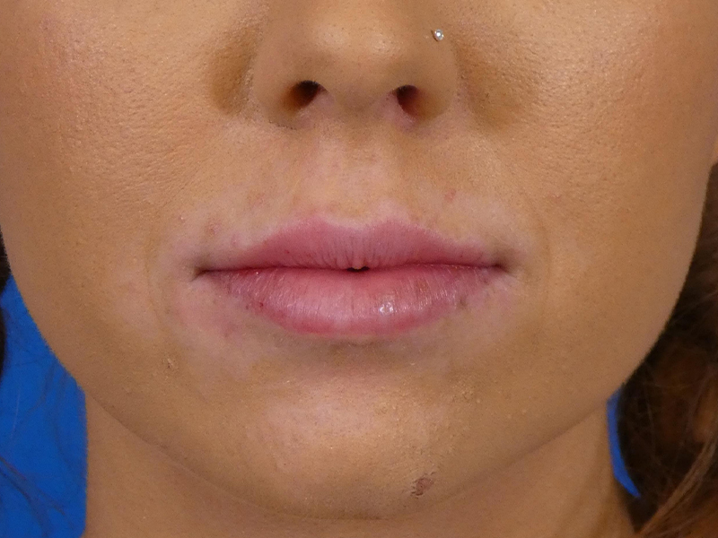 Lip Filler Before and After | Plastic Surgery Associates of Valdosta