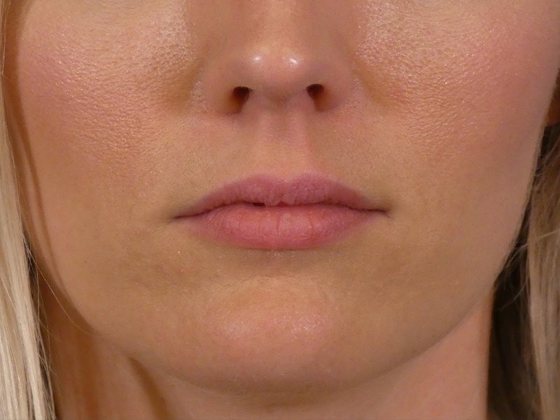 Lip Filler Before and After | Plastic Surgery Associates of Valdosta