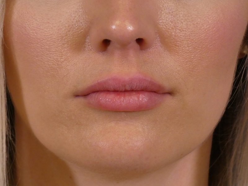Lip Filler Before and After | Plastic Surgery Associates of Valdosta