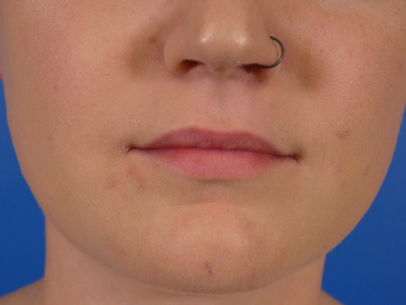 Lip Filler Before and After | Plastic Surgery Associates of Valdosta