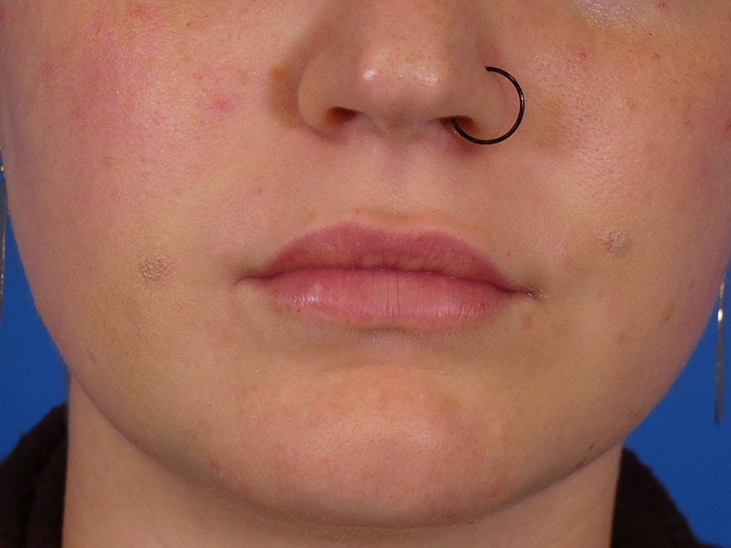 Lip Filler Before and After | Plastic Surgery Associates of Valdosta