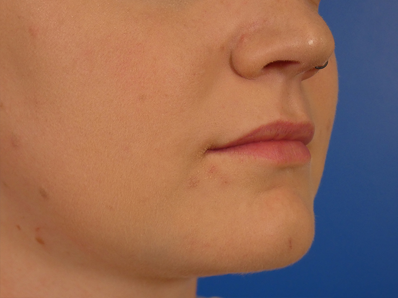 Lip Filler Before and After | Plastic Surgery Associates of Valdosta