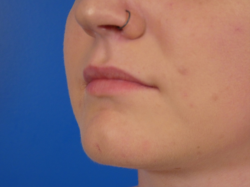 Lip Filler Before and After | Plastic Surgery Associates of Valdosta