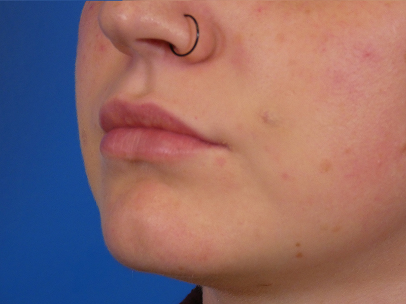 Lip Filler Before and After | Plastic Surgery Associates of Valdosta