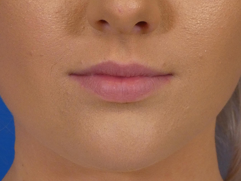 Lip Filler Before and After | Plastic Surgery Associates of Valdosta