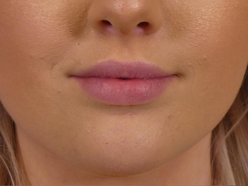 Lip Filler Before and After | Plastic Surgery Associates of Valdosta