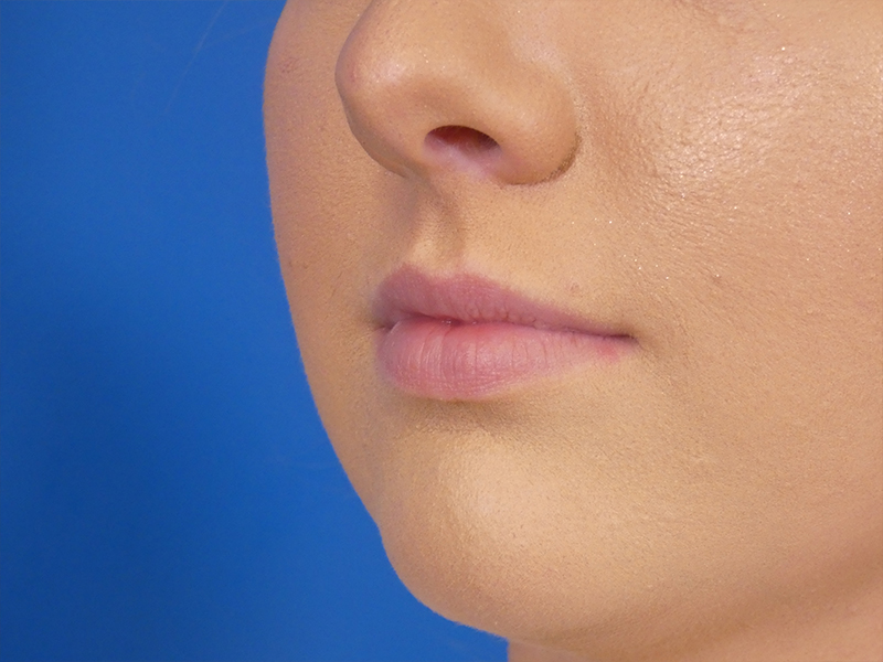 Lip Filler Before and After | Plastic Surgery Associates of Valdosta