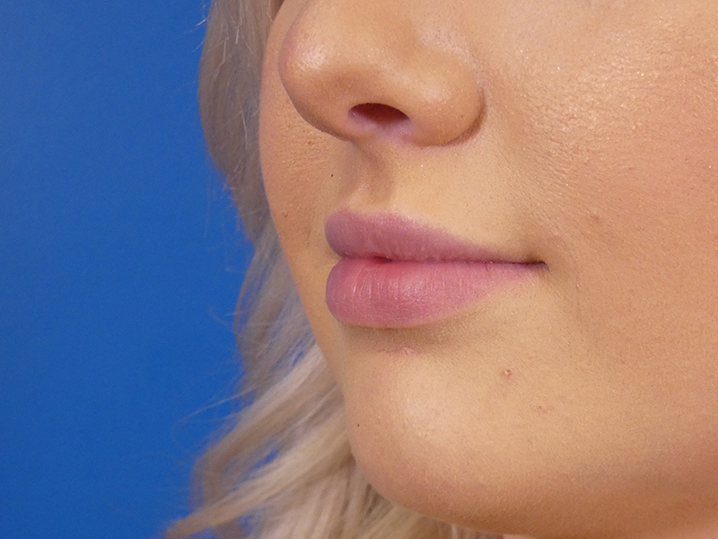 Lip Filler Before and After | Plastic Surgery Associates of Valdosta