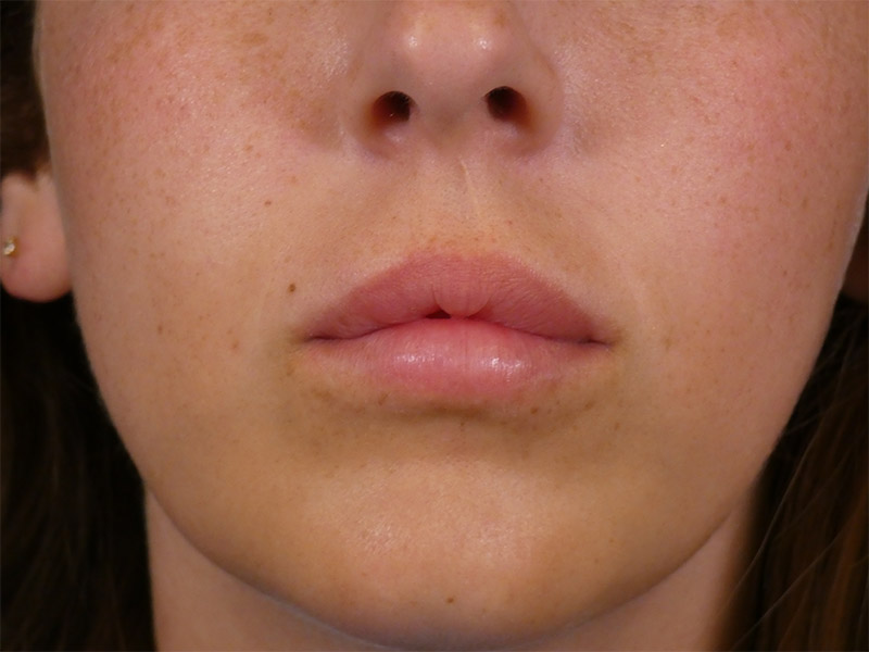 Lip Filler Before and After | Plastic Surgery Associates of Valdosta