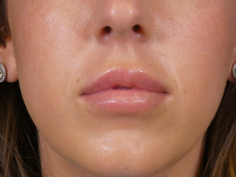 Lip Filler Before and After | Plastic Surgery Associates of Valdosta