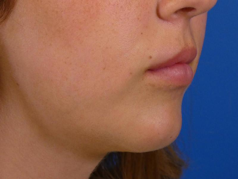 Lip Filler Before and After | Plastic Surgery Associates of Valdosta