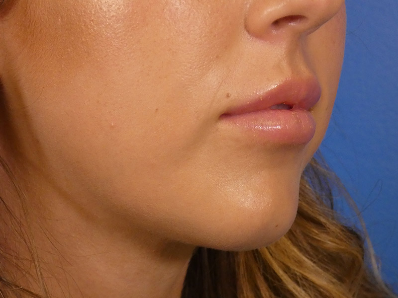 Lip Filler Before and After | Plastic Surgery Associates of Valdosta