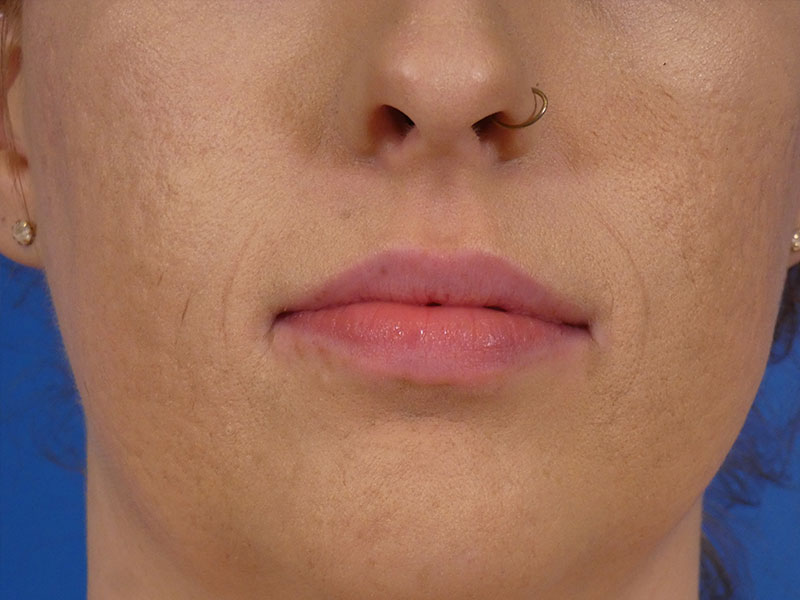 Lip Filler Before and After | Plastic Surgery Associates of Valdosta