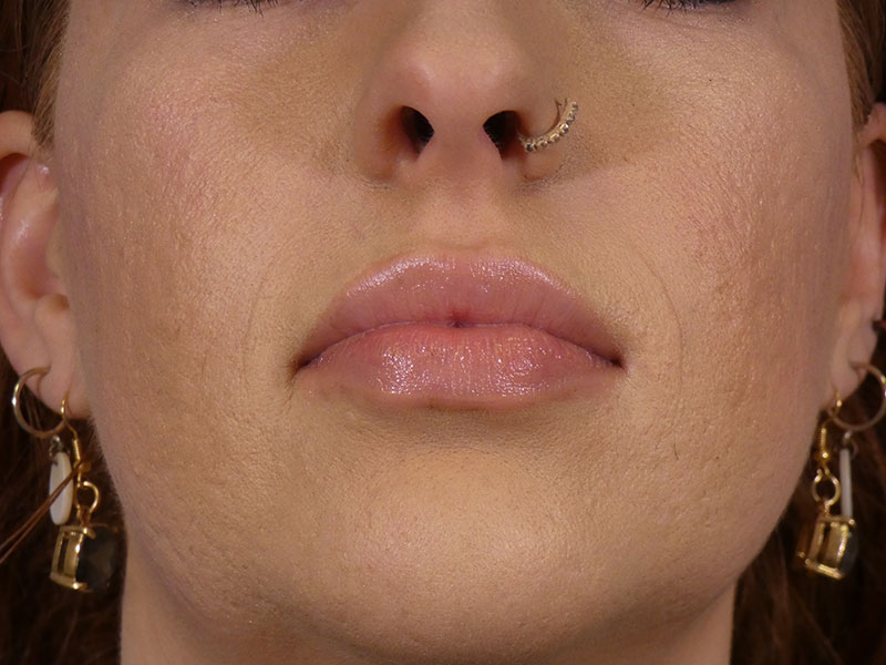 Lip Filler Before and After | Plastic Surgery Associates of Valdosta