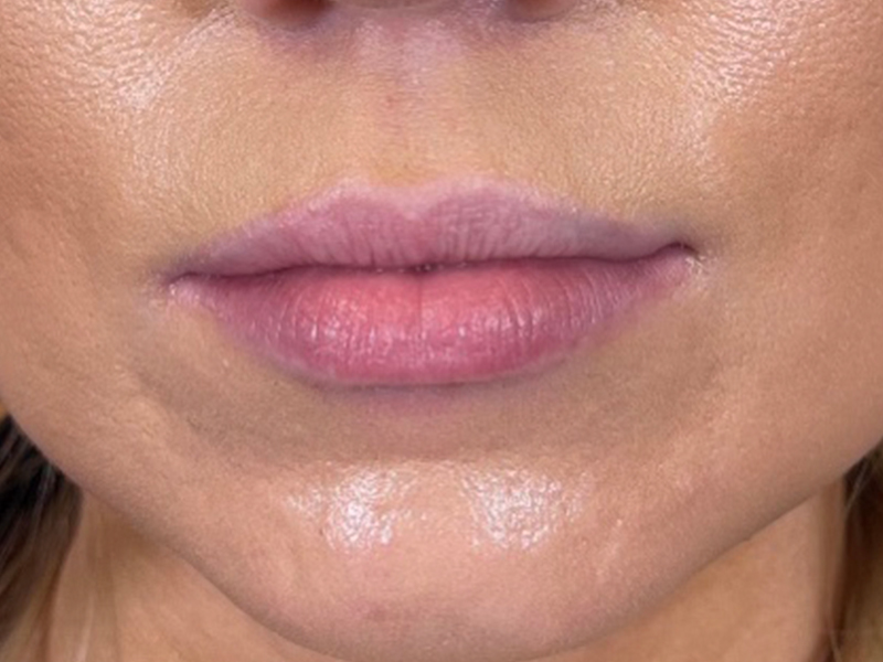 Lip Filler Before and After | Plastic Surgery Associates of Valdosta