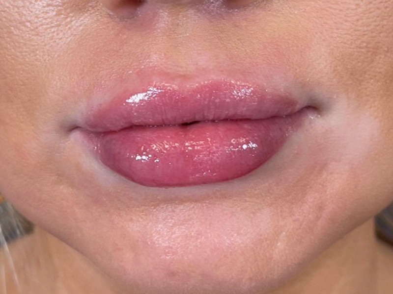 Lip Filler Before and After | Plastic Surgery Associates of Valdosta